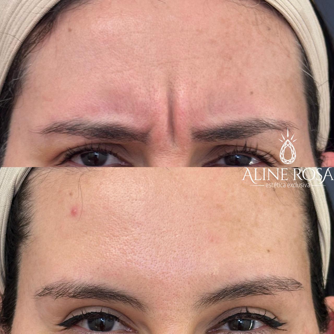 Botox Terço Superior Feminino